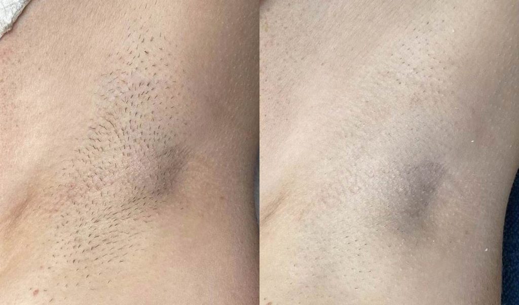 before-after-results-laser